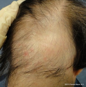 Areata Alopecia on Alopecia Areata