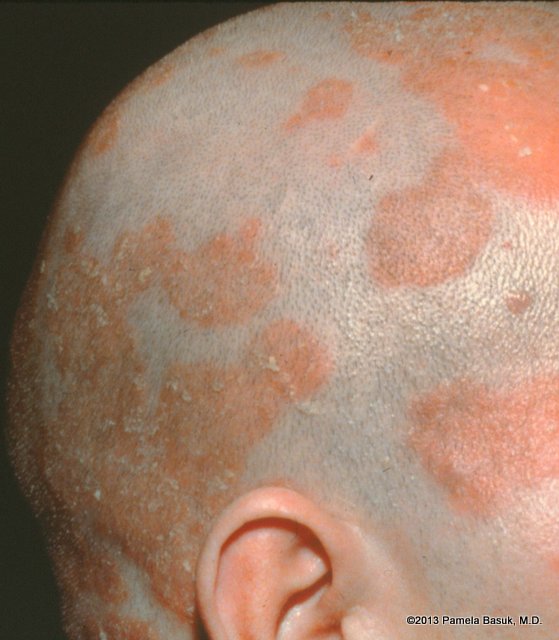Seborrheic Dermatitis | National Eczema Association